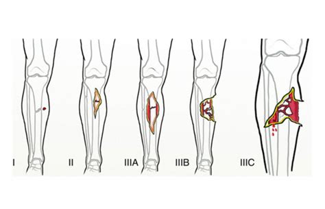 Open fracture